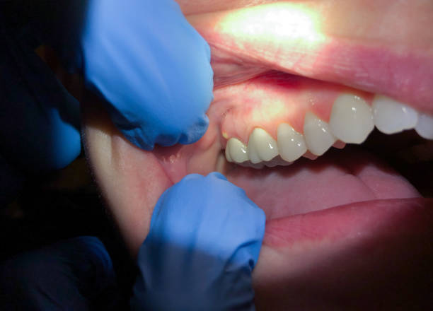 Best Emergency Dentist for Knocked-Out Tooth in Aberdeen, WA